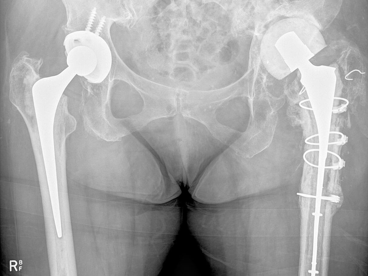 Revision total hip replacement